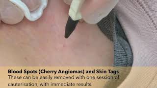 Blood Spots (Cherry Angiomas) and Skin Tag Removal Treatment