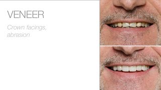 A new smile with edelweiss VENEERs