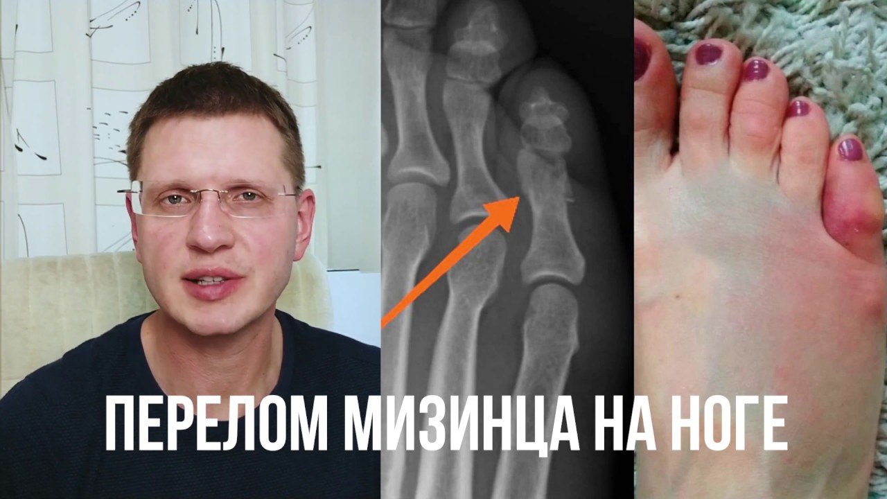 Перелом мизинца на ноге. Как лечить
