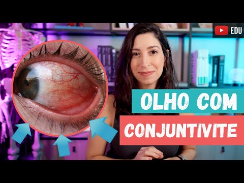 Eye Anatomy and Conjunctivitis
