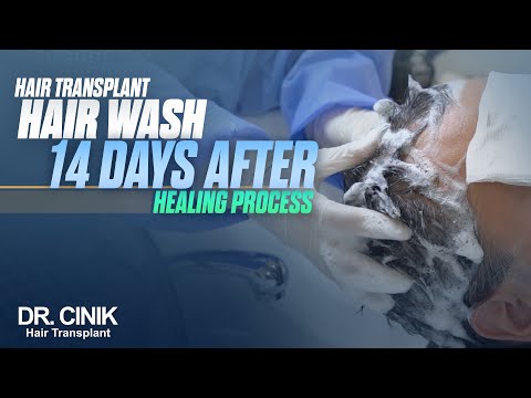 Dr.Cinik Hair Transplant | 14 Days Hair Wash After Healing Process