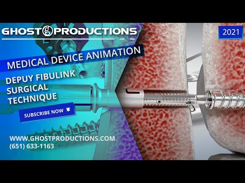 Ankle Fracture Repair - DePuy FibuLINK Surgical Technique