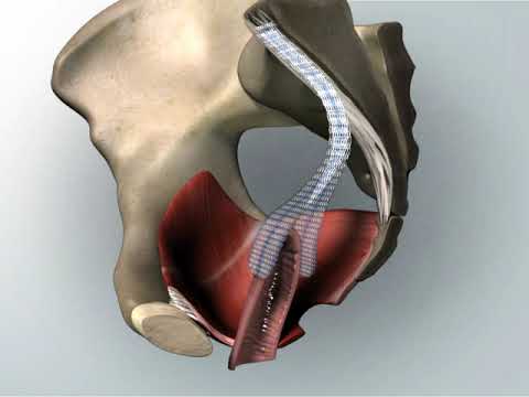 Sacrocolpopexy. Animated video about pelvic prolaps surgery