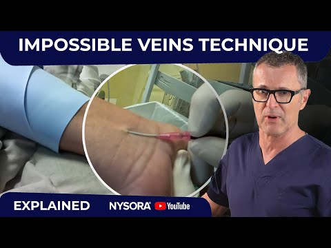 Difficult veins - Made Much Easier with this technique!