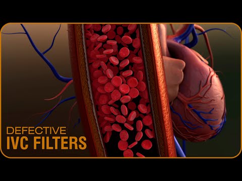 Defective IVC Filters