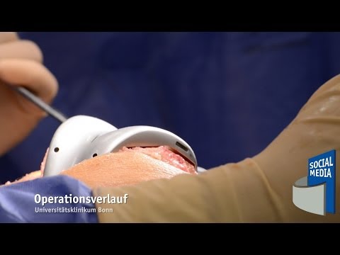 Schmerzen im Schultergelenk während des Schlafes Röntgenuntersuchung der Gelenke