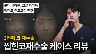 3번째 코재수술 찝힌코재수술 케이스 리뷰 [늑떼선생김현주의 수술사례 및 케이스리뷰]
