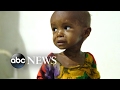 Children in Somalia are malnourished and fighting for their lives