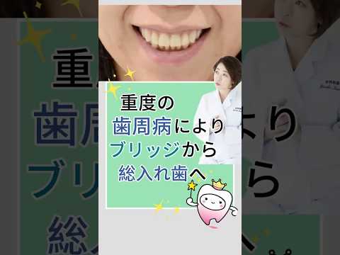 重度の歯周病によりブリッジから総入れ歯へ
