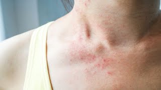 how to get rid of an itchy rash on skin fast