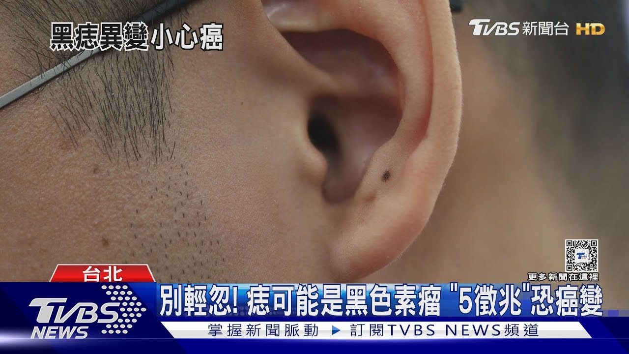 別輕忽！痣可能是黑色素瘤　「5徵兆」恐癌變