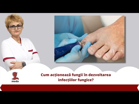 Tratamentul artrozei artritei la mâini