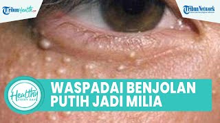 Waspadai Munculnya Benjolan Putih Kecil pada Wajah Bisa Jadi Milia, Ini Penjalasan dr. Anggy Resti