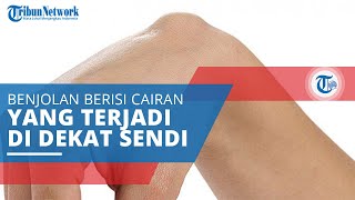 Kista Ganglion, Benjolan Berisi Cairan yang Terjadi di Dekat Sendi atau Tendon