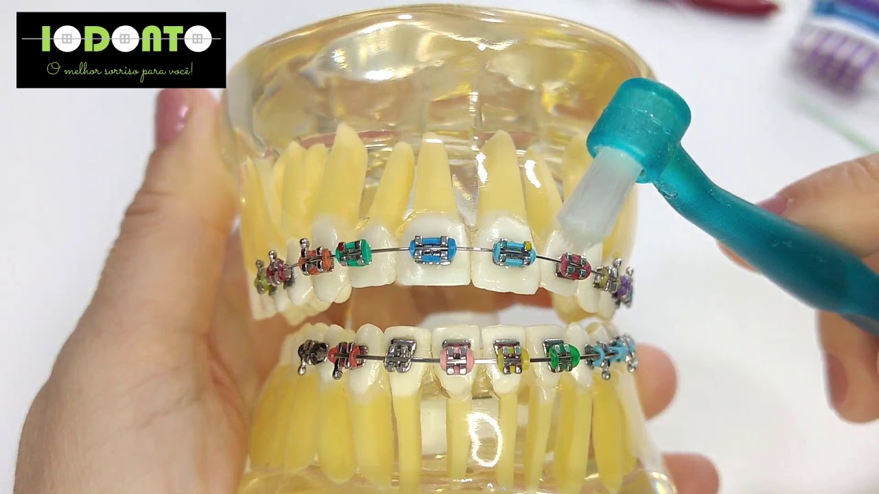 Saiba como escovar os dentes com aparelho ortodôntico fixo.
