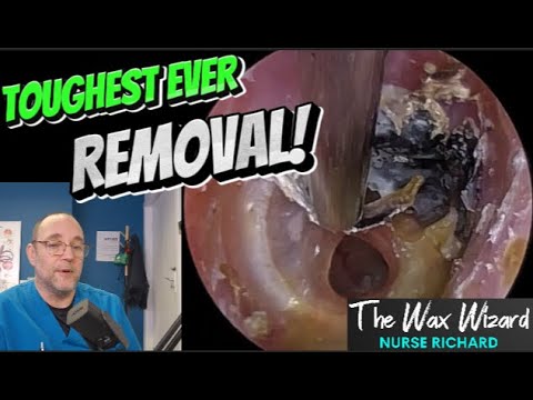TOUGHEST EVER REMOVAL! 412 #ear #earwax #earwaxremoval #asmr #satisfying #foryou #fyp #foryourpage