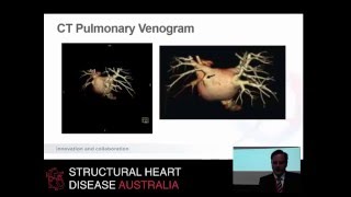 Pulmonary vein stenosis & stenting post-ablation – Prof Darren Walters