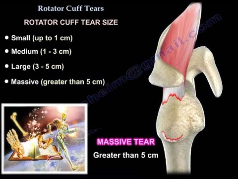 Blessure à la déchirure de la coiffe des rotateurs