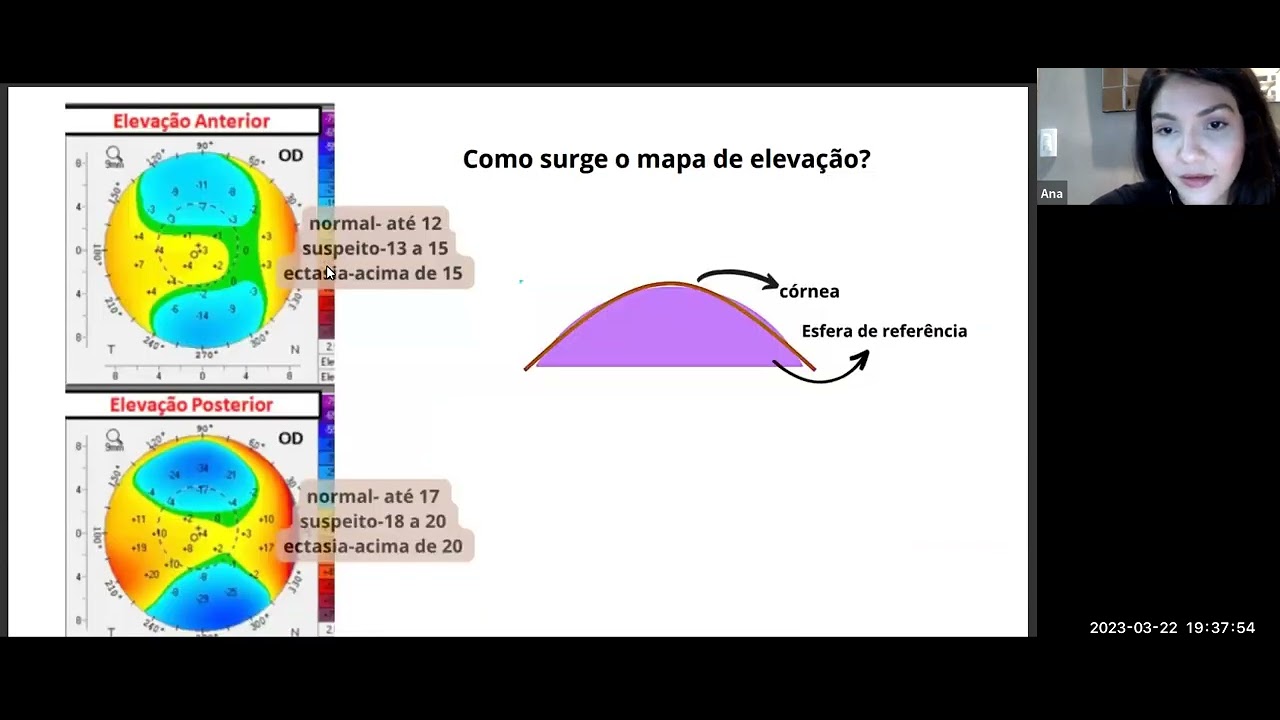 TOMOGRAFIA DE CORNEA, OCT CORNEA E MAPA EPITELIAL