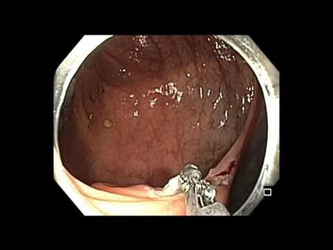 Colonoscopia - resección de pólipo de circunferencia 50% de la válvula IC