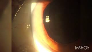 Limpieza de lente intraocular Capsulotomia Yag Laser antes y después. 27 05 2021