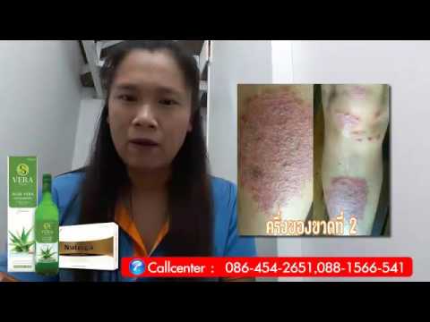 โรคสะเก็ดเงินรักษา celandine น้ำซุป สิ่งที่ทดสอบต้องผ่าน neurodermatitis