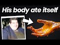 The Man Who Let His Body Eat Itself