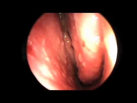 Endoscopy of Nasal Cavity and Sinuses