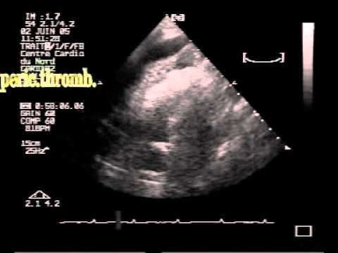 Myocardial Infarction, Pericardial Effusion With Thrombus: Left Ventricular Free Wall Rupture