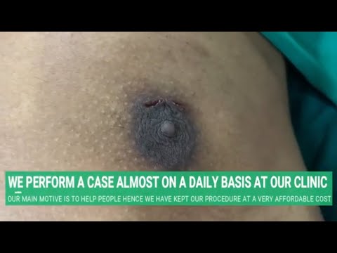 PUFFY NIPPLE SURGERY RESULTS WITH SCARLESS KEYHOLE GYNECOMASTIA TECHNIQUE