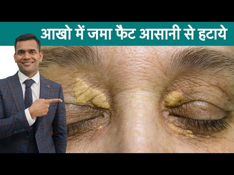आखों पर जमा फैट हटाए आसानी से | Xanthelasma Treatment Easy And Simple Treatment