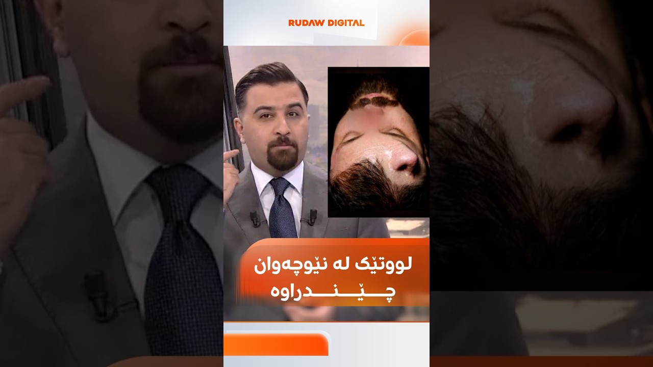 ڤیدیۆ | کرێکارێک کارەبا گرتوویەتی و بەشێکی لووتی لەدەستداوە، پزیشکێک لووتی لە نێوچەوانی بۆ چاندووەتەوە