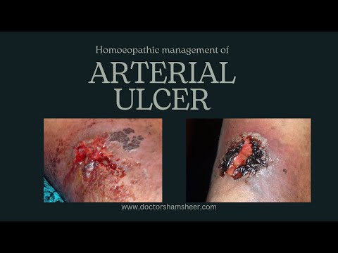 ARTERIAL ULCER