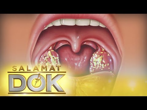 , title : 'Salamat Dok: Information about tonsil stones