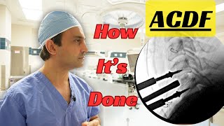 Anterior Cervical Diskectomy & Fusion