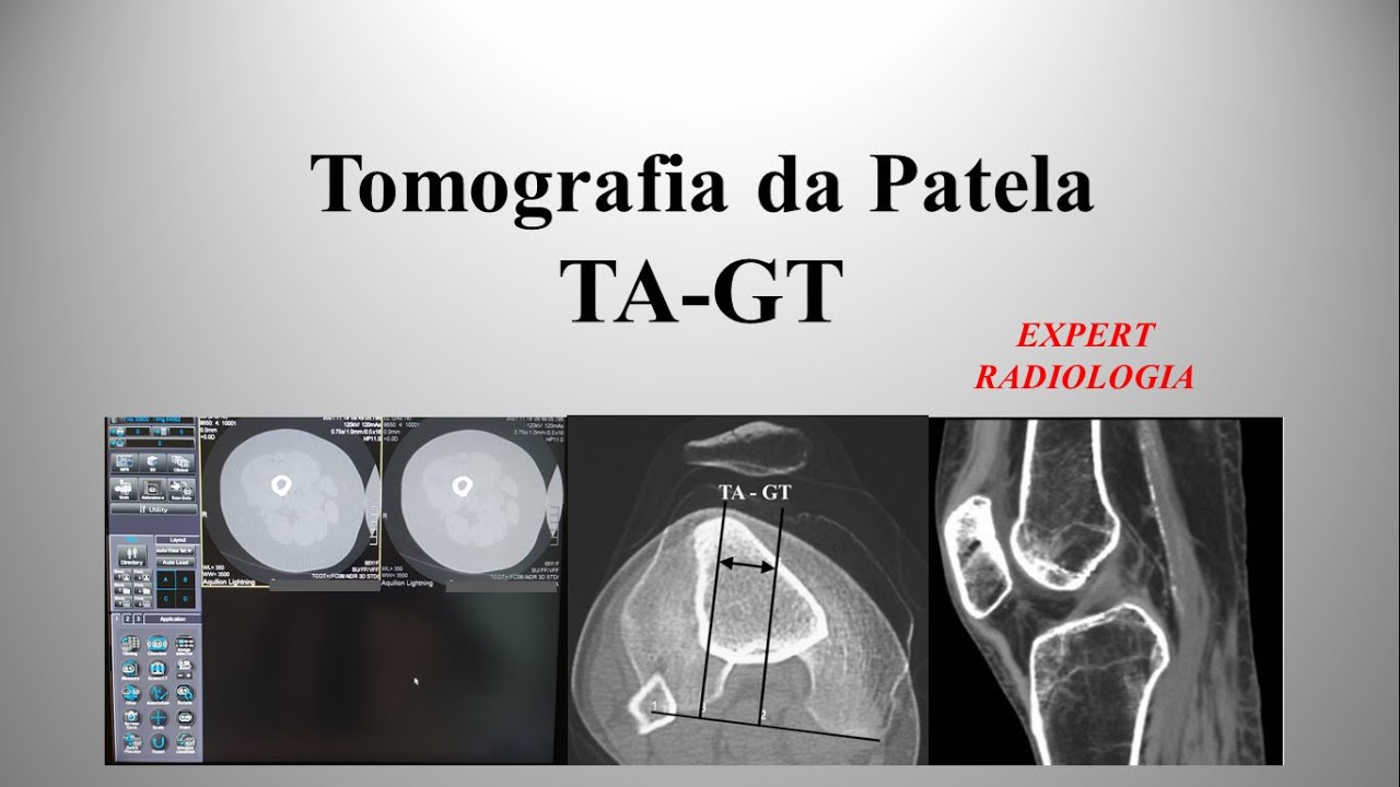 Tomografia da Patela (TA-GT)