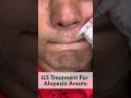 ILS Treatment For Alopecia Areata Alopecia Areata Beard Treatment Skinaa Clinic Shorts Viral