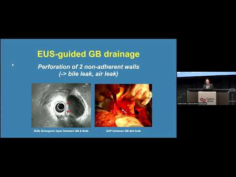 Lecture: "Management of acute cholecystitis in surgically unfit patients"