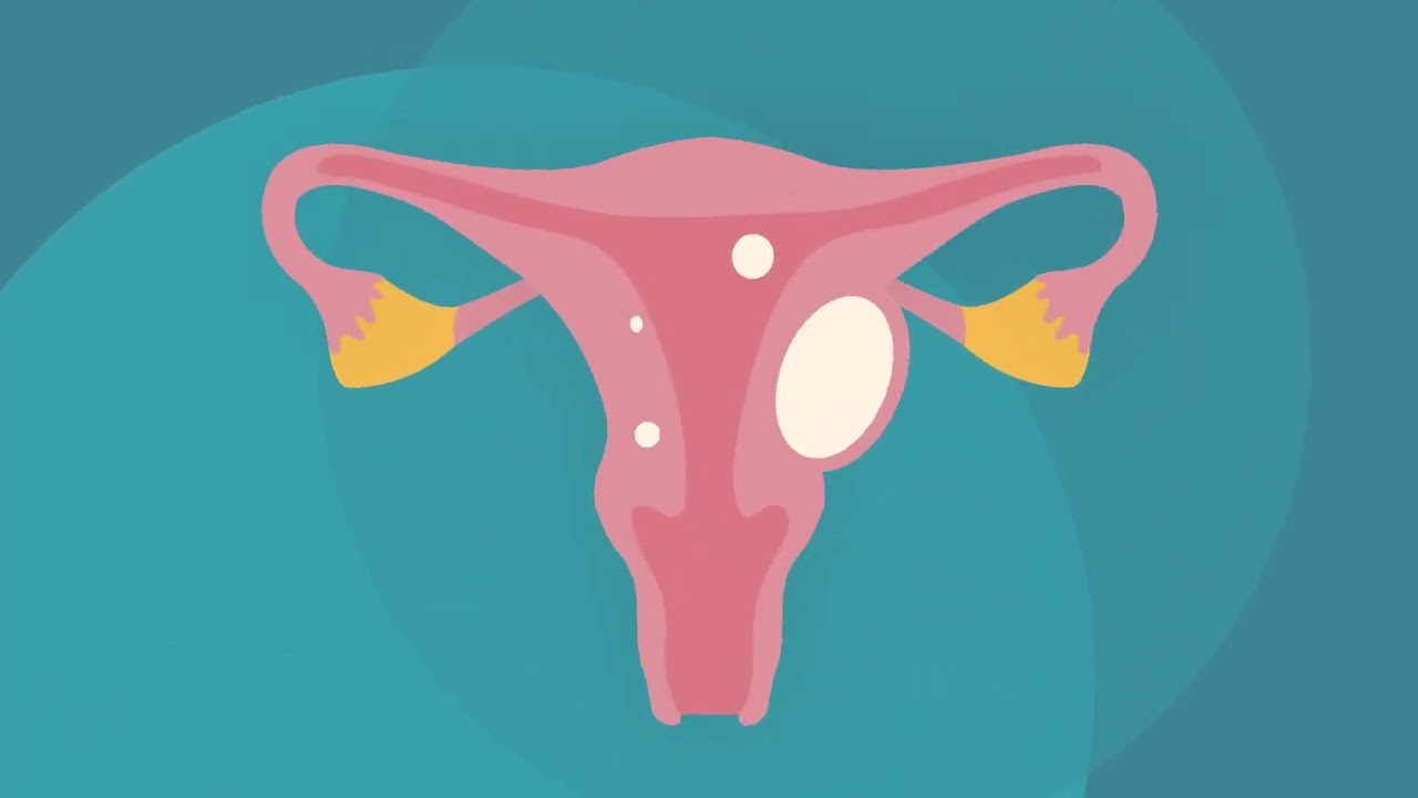 Uterine Fibroids and Pregnancy