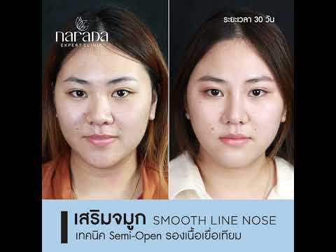 หน้าสวยหวานขึ้น อย่างเป็นธรรมชาติ ด้วยการ เสริมจมูก เทคนิค Semi-Open รองเนื้อเยื่อเทียม หน้าสวยหวานขึ้น อย่างเป็นธรรมชาติ ด้วยการ เสริมจมูก เทคนิค Semi-Open รองเนื้อเยื่อเทียม