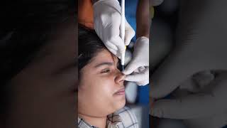 Download lagu Mole Removal | RF Mole removal mp3 Download lagu Mole Removal | RF Mole removal mp3