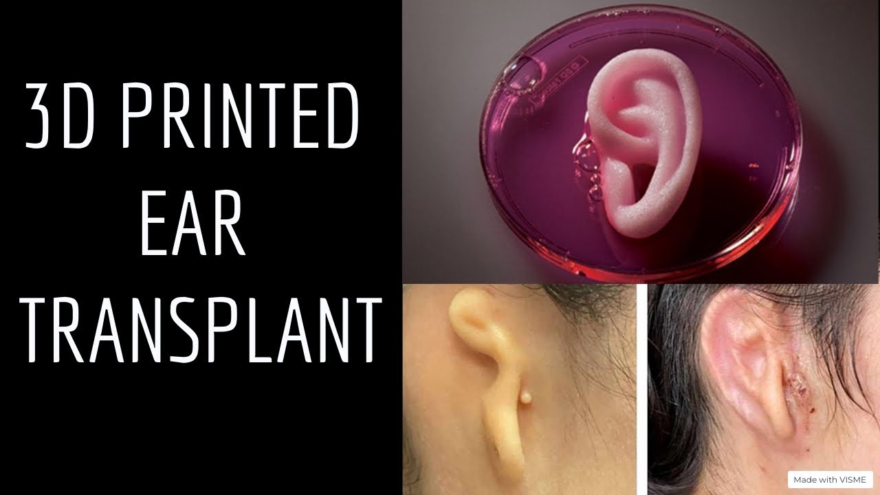 FAC Time broadcast on the first 3D-bioprinted ear transplant — the first implant made of living tissue