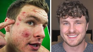 Doing This ONE THING Got Rid of My Acne!