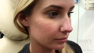 Removing acne scars in 5 minutes