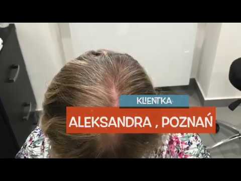 Letual wypadanie włosów Włosów wypada po wątroby