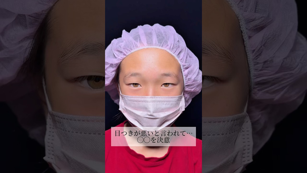 【二重整形】#shorts 目つきが悪いと言われて…
