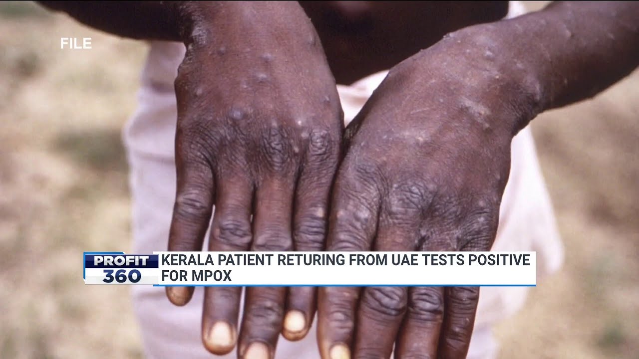 India Reports First Case Of MPOX Clade 1 Strian: Kerala Patient Returning From UAE Tests Positive