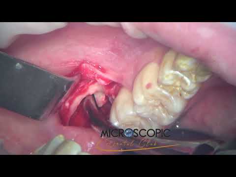 Microscopic oral surgery