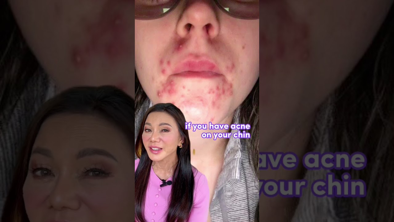 Where your #acne is and what it means!