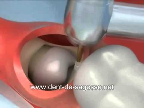 comment soulager douleur apres extraction dents sagesse